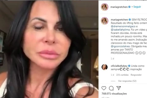 Gretchen mostra resultado de plástica nas redes sociais; veja!