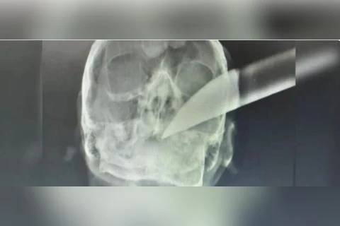 Com faca cravada na cabeça, vítima de assalto consegue pedir socorro e é hospitalizado