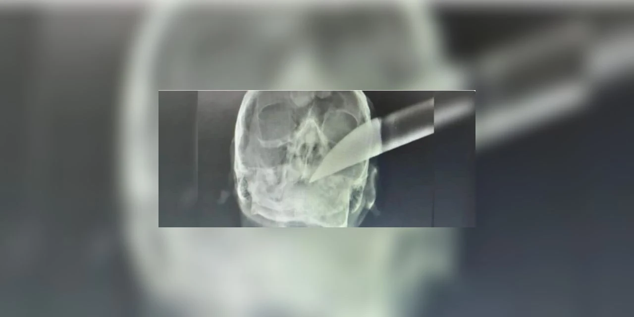 Com faca cravada na cabeça, vítima de assalto consegue pedir socorro e é hospitalizado