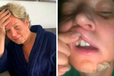 Joice Hasselmann diz que foi atacada mas sem lembranças das agressões