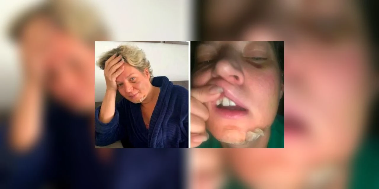 Joice Hasselmann diz que foi atacada mas sem lembranças das agressões