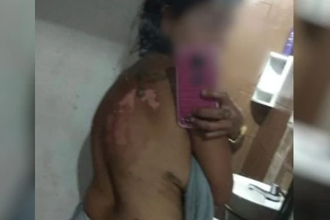 Homem é preso suspeito de jogar óleo quente nas costas da companheira, em Goiás