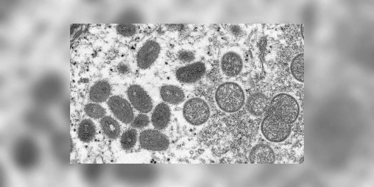 Brasil tem mais de 200 casos confirmados de varíola dos macacos