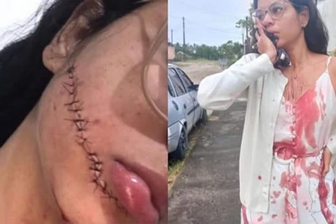 Vídeo mostra momento em que jovem tem rosto cortado durante viagem de ônibus; Assista