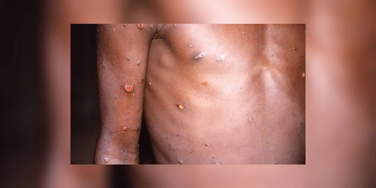 OMS mantém alerta de emergência de saúde pública para Mpox; Paraná registrou 11 novos casos