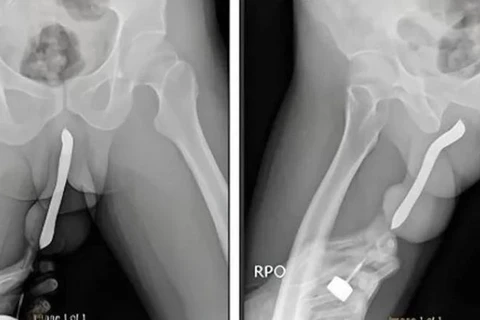 Homem vai parar no hospital após inserir uma escova de dente no órgão sexual