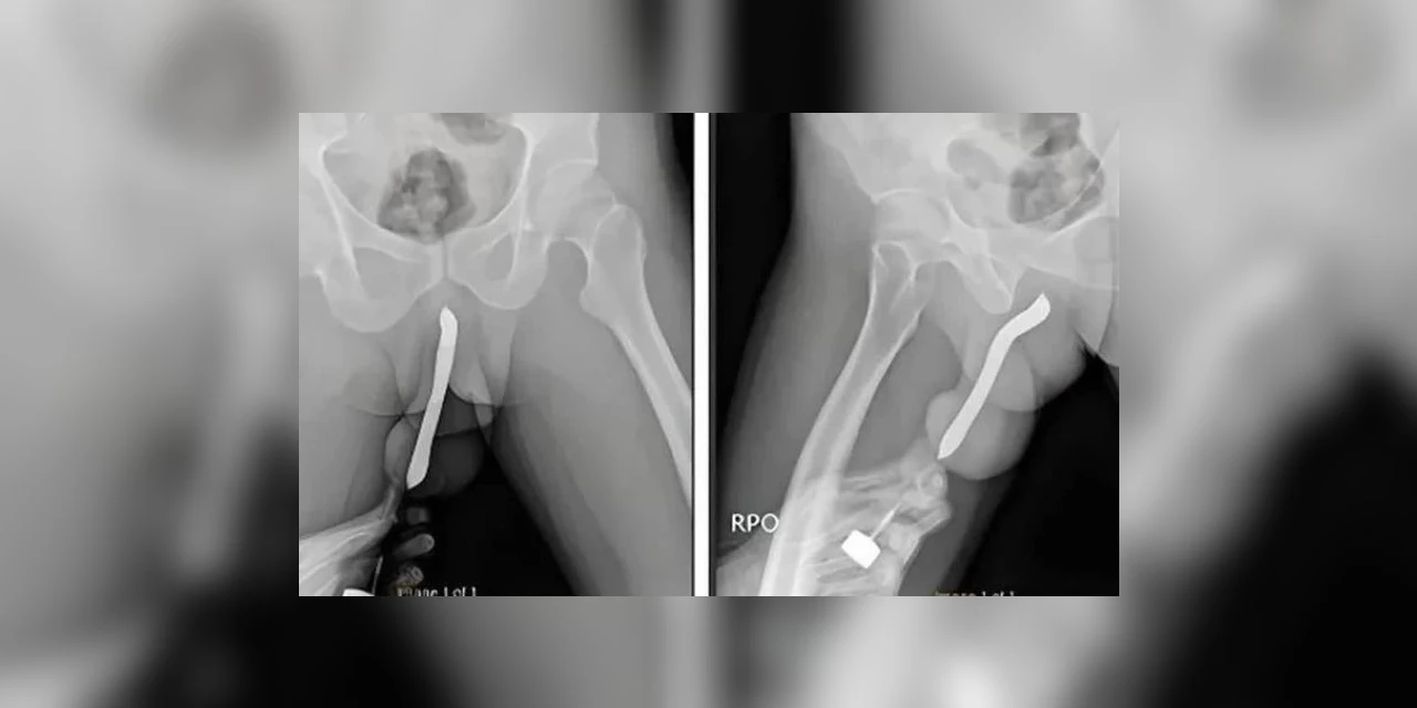 Homem vai parar no hospital após inserir uma escova de dente no órgão sexual