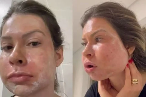 Paranaense fica com rosto deformado após harmonização facial: "Medo de morrer"