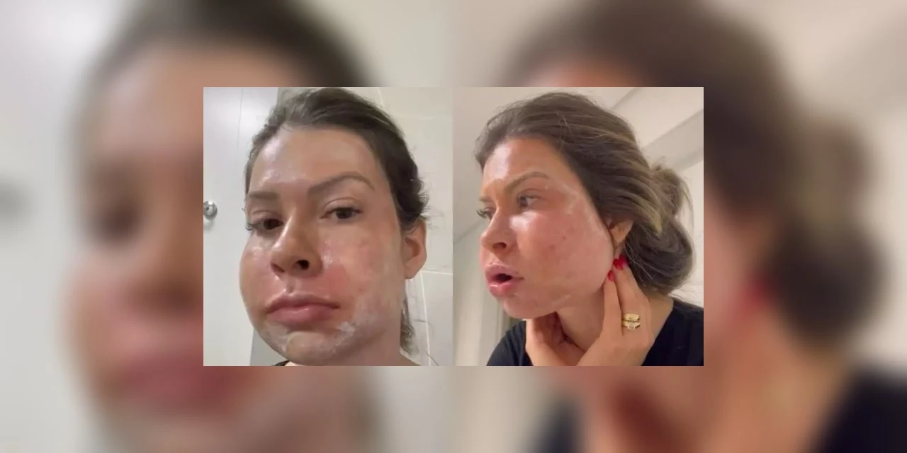 Paranaense fica com rosto deformado após harmonização facial: "Medo de morrer"