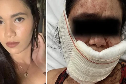 Mulher tem rosto desfigurado por mordidas do próprio namorado após rir dele