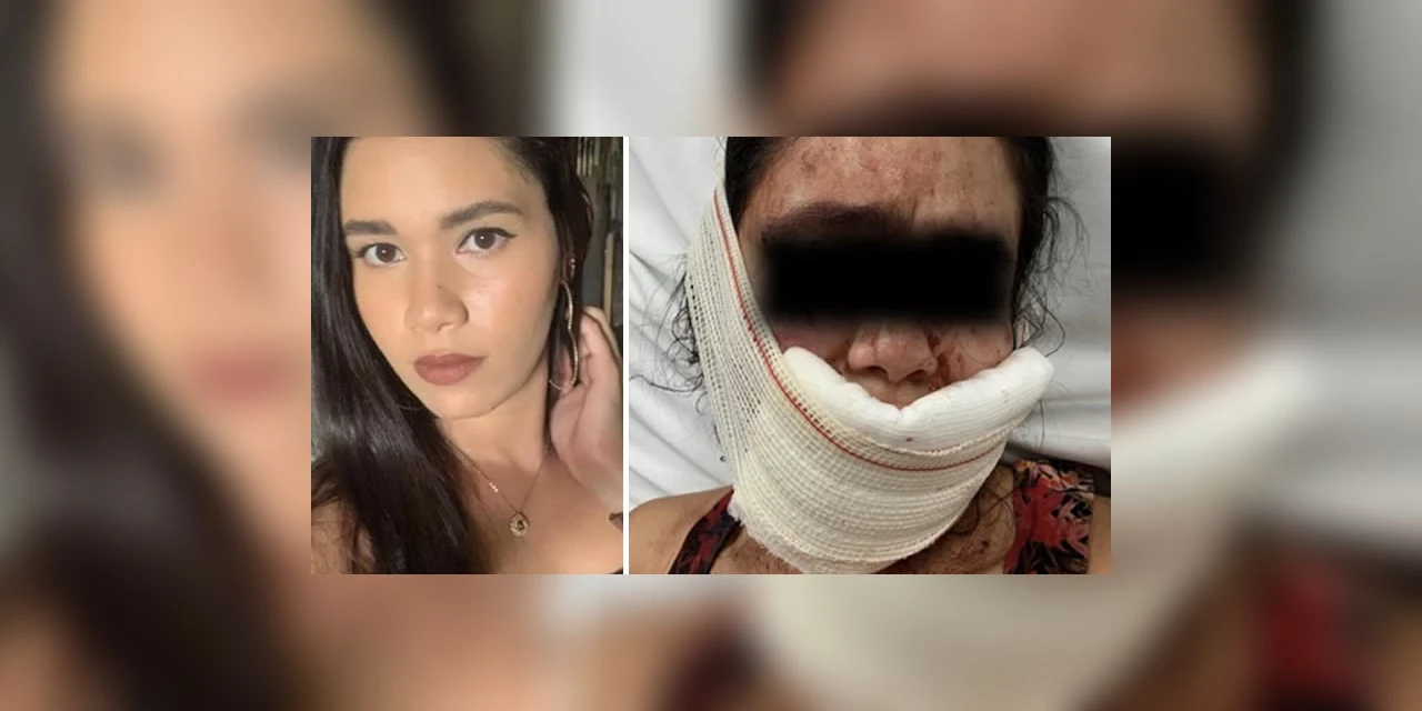 Mulher tem rosto desfigurado por mordidas do próprio namorado após rir dele