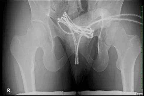 Homem é internado após enfiar cabo USB no pênis e objeto ficar preso