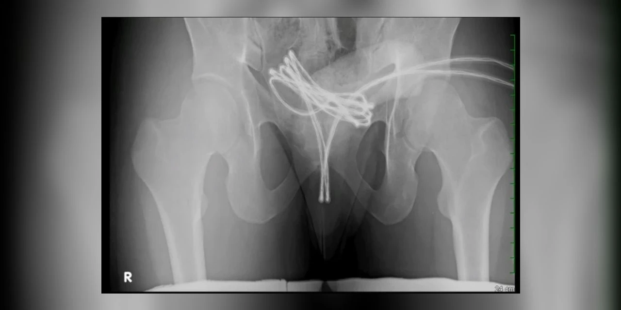 Homem é internado após enfiar cabo USB no pênis e objeto ficar preso