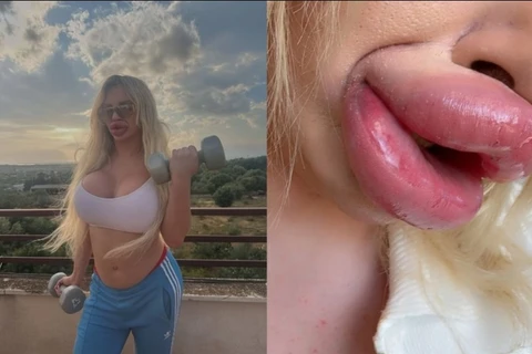 Influencer não consegue mais fechar a boca após preenchimentos labiais