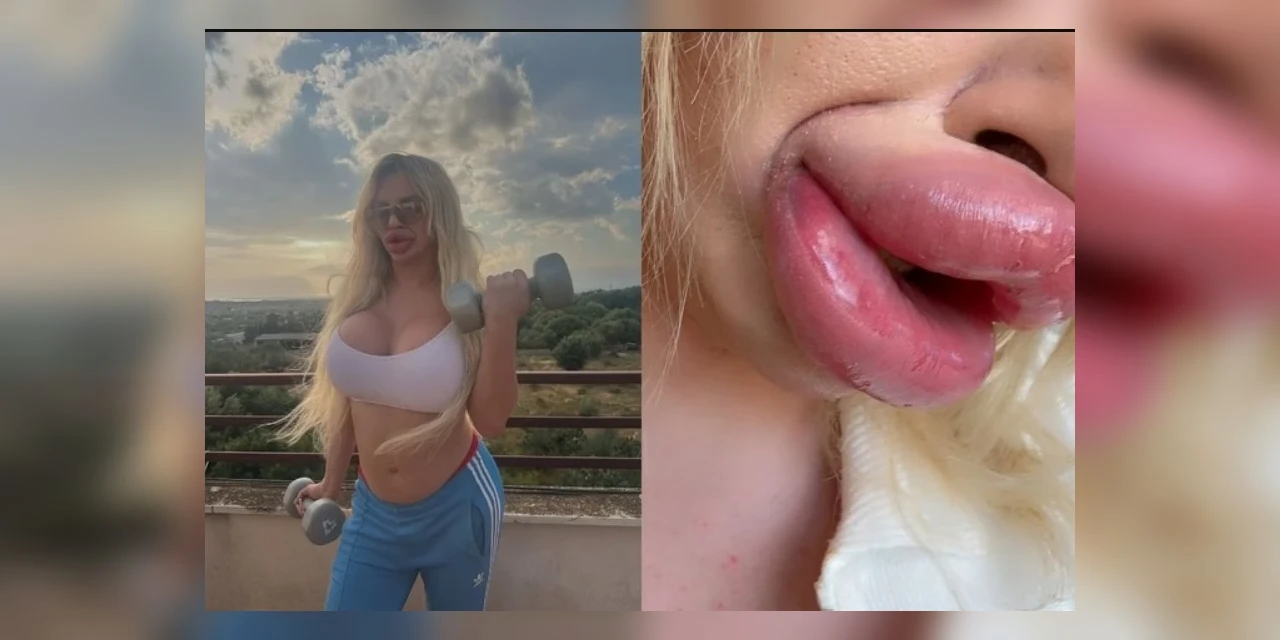 Influencer não consegue mais fechar a boca após preenchimentos labiais